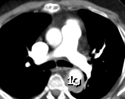 Bolus-track Angio-TC Aorta (ROI all’origine dell’aorta discendente)