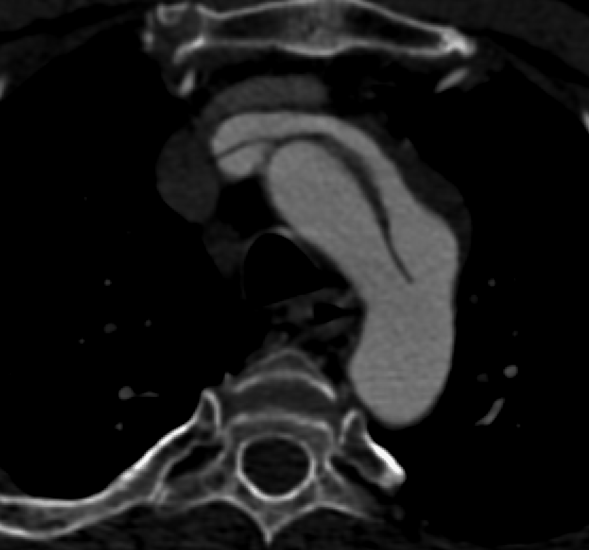 Dissecazione aorto-carotidea