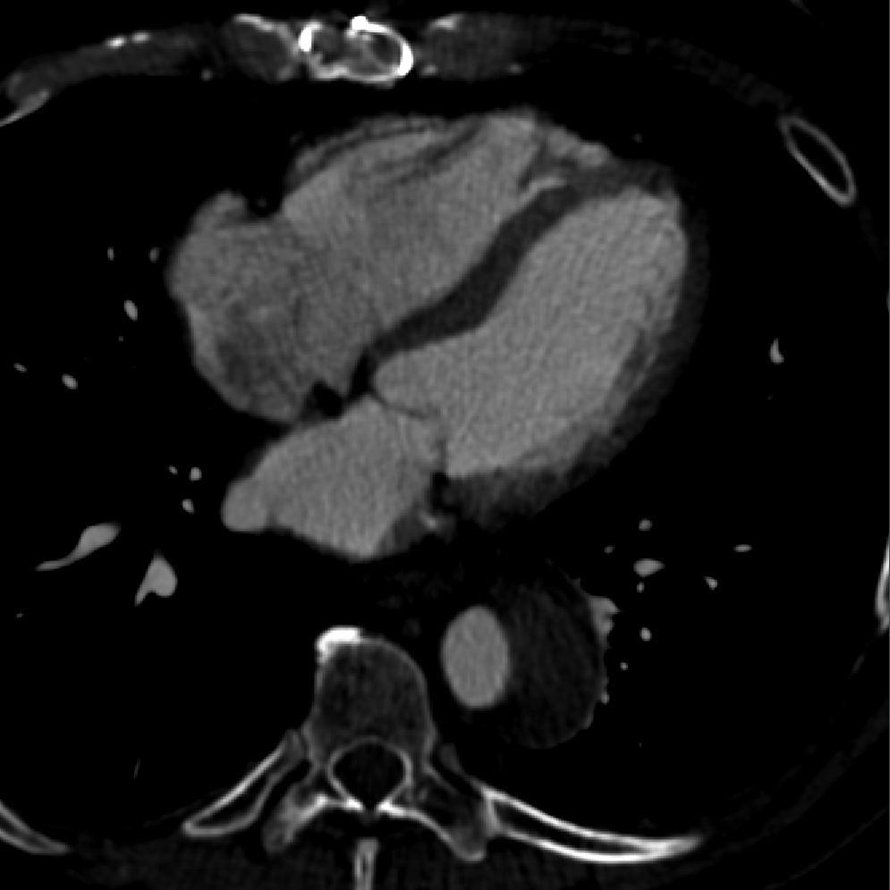 Dissecazione aorta addominale