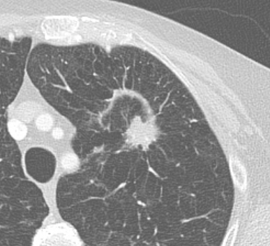 Nodulo a margini spiculati sospetto per lesione proliferativa a livello del lobo superiore di sinistra.