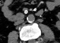 Aorta calcifica