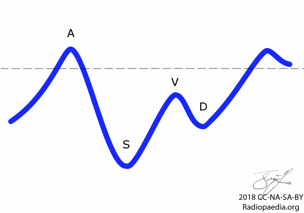 Spettro doppler fisiologico in vene epatiche